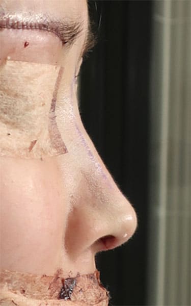 鼻中隔延長、鼻尖軟骨移植、鼻尖縮小、Ｉ型プロテーゼ　手術直後　右側面のAfterの写真