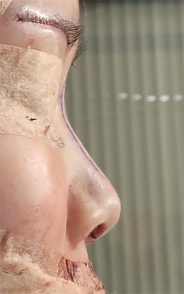 鼻中隔延長、鼻尖軟骨移植、鼻尖縮小、Ｉ型プロテーゼ　手術直後　右側面のBefore写真