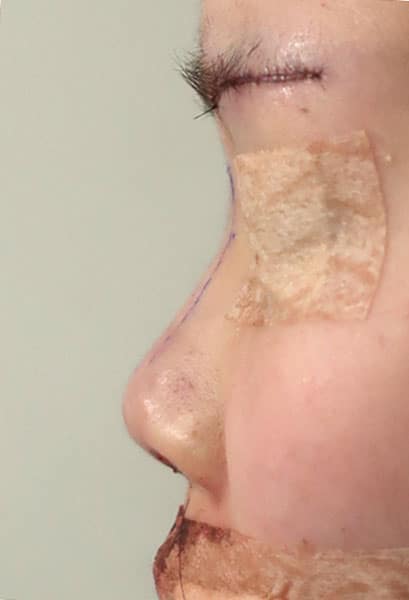 鼻中隔延長、鼻尖軟骨移植、鼻尖縮小、Ｉ型プロテーゼ　手術直後　左側面のBefore写真