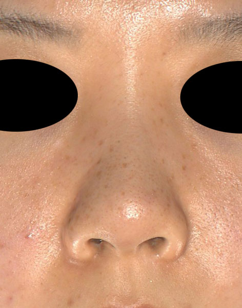 鼻尖縮小（３D法）、ストラット、軟骨移植　半年後のBefore写真