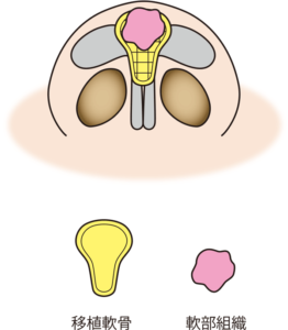 鼻尖軟骨移植のイラスト図
