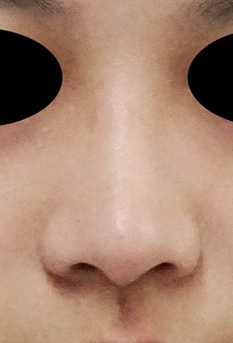 鼻翼縮小（内側法＋外側法）　3ヶ月後　正面のBefore写真