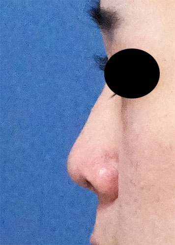 鼻尖縮小、軟骨移植　手術前　左側面
