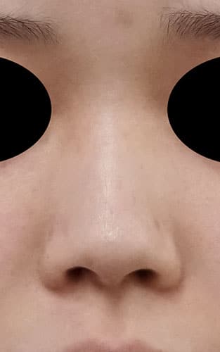 鼻中隔延長、鼻尖縮小、プロテーゼ　1ヶ月後　正面のBefore写真