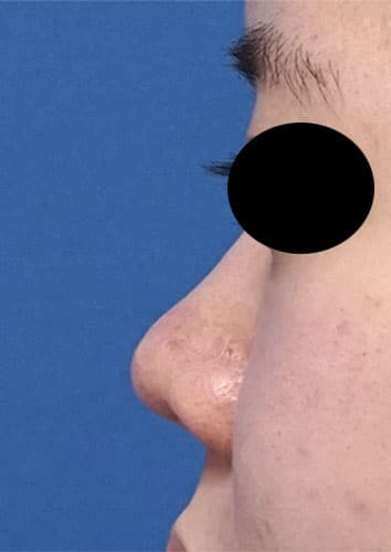 鼻尖縮小、軟骨移植、鼻柱基部下降、鼻翼縮小(内側＋外側)　3ヶ月後　左側面のBefore写真