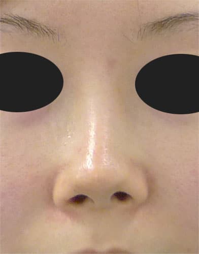 鼻中隔延長、鼻尖縮小、Ｉ型プロテーゼ　3か月後　正面のBefore写真