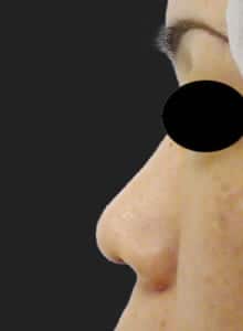鼻柱基部下降（軟骨移植）　手術前　左側面