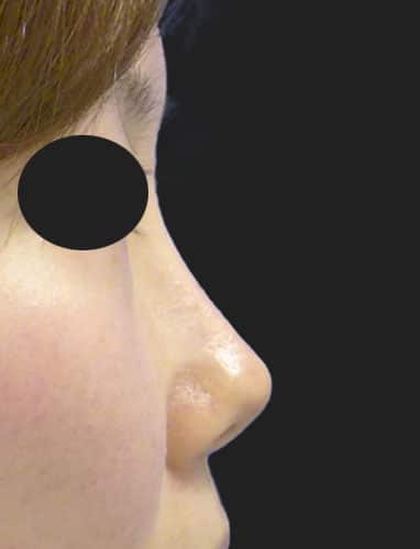 鼻中隔延長、鼻尖縮小、Ｉ型プロテーゼ　3か月後　右側面のBefore写真