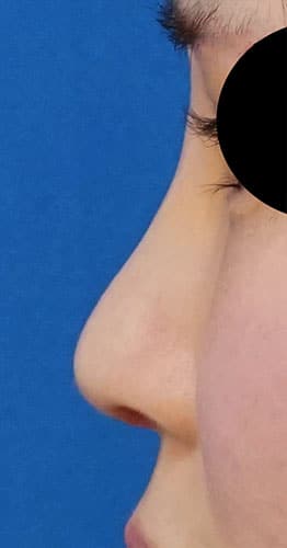 鼻中隔延長、鼻尖縮小、プロテーゼ　1ヶ月後　左側面のAfterの写真