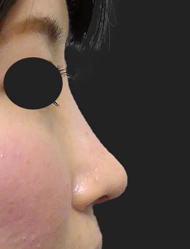 鼻中隔延長、鼻尖縮小、Ｉ型プロテーゼ　3か月後　右側面のAfterの写真