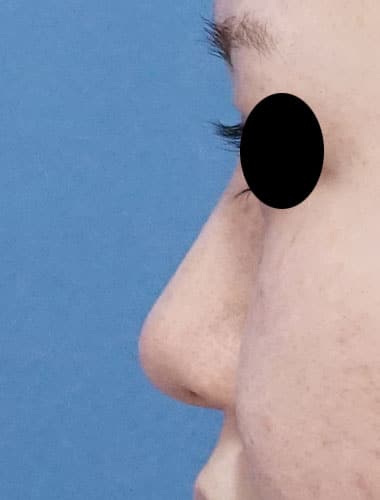 鼻尖縮小、Ｉ型プロテーゼ　3ヶ月後　左側面のBefore写真