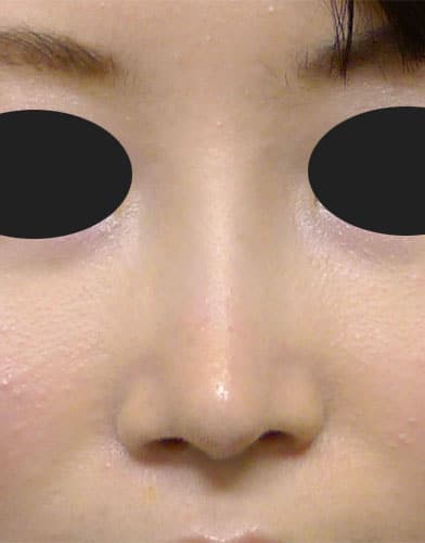鼻中隔延長、鼻尖縮小、Ｉ型プロテーゼ　3か月後　正面のAfterの写真