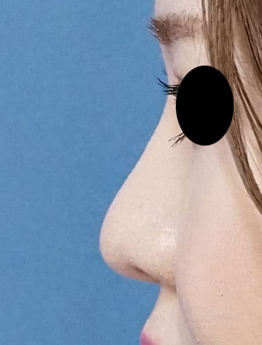 鼻尖縮小、Ｉ型プロテーゼ　3ヶ月後　左側面のAfterの写真