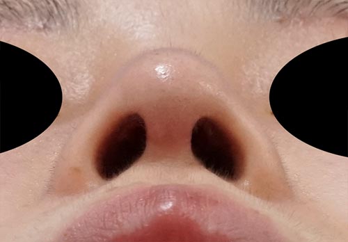 鼻中隔延長、鼻尖縮小、プロテーゼ　1ヶ月後　下からのAfterの写真