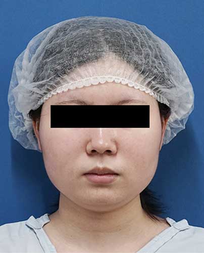 小顔脂肪吸引（ほほ・アゴ下・法令線）、ゼオミン強力小顔ボトックス　３ヶ月後　正面のBefore写真