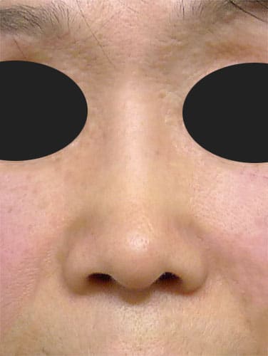 鼻尖縮小、鼻中隔延長、プロテーゼ　1ヶ月後　正面のAfterの写真