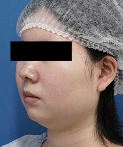 小顔脂肪吸引（ほほ・アゴ下・法令線）、ゼオミン強力小顔ボトックス　３ヶ月後　左斜めのBefore写真