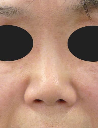 鼻尖縮小、鼻中隔延長、プロテーゼ　1ヶ月後　正面のBefore写真