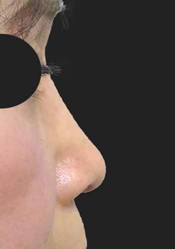 鼻尖縮小、鼻中隔延長、プロテーゼ　1ヶ月後　右側面のAfterの写真