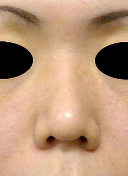 鼻柱基部下降（軟骨移植）　半年後　正面のBefore写真