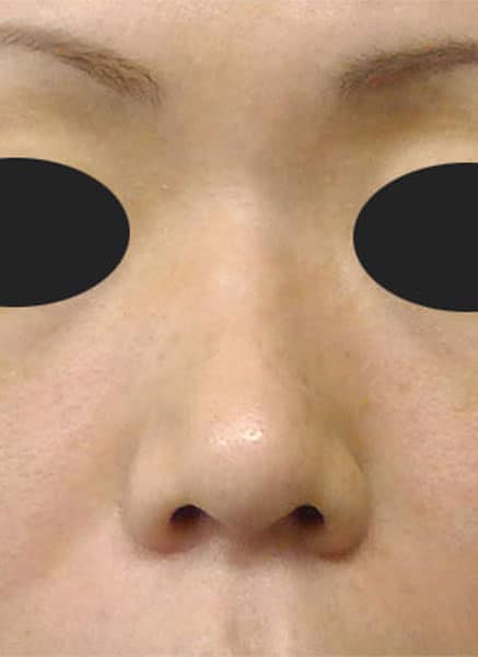 鼻柱基部下降（軟骨移植）　半年後　正面のAfterの写真