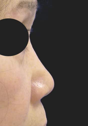 鼻尖縮小、鼻中隔延長、プロテーゼ　1ヶ月後　右側面のBefore写真