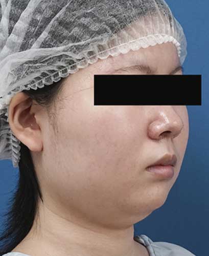 小顔脂肪吸引（ほほ・アゴ下・法令線）、ゼオミン強力小顔ボトックス　３ヶ月後　右斜めのBefore写真