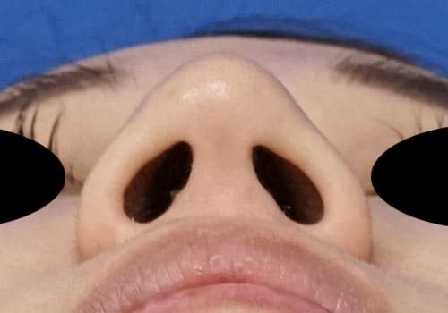 鼻尖縮小（３D法）、ストラット　３ヶ月後　下からのAfterの写真