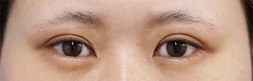 切らない眼瞼下垂　１ヶ月後のBefore写真