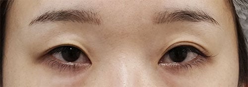 切らない眼瞼下垂プレミアム　３ヶ月後のBefore写真