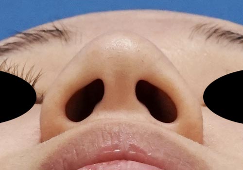 鼻尖縮小（３D法）、ストラット　３ヶ月後　下からのBefore写真