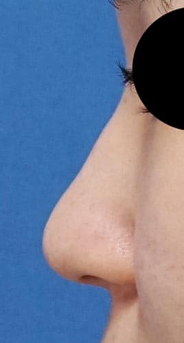 鼻尖縮小（３D法）、ストラット　３ヶ月後　左側面のBefore写真