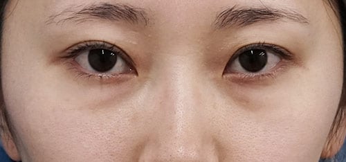 下眼瞼下制（切るタレ目）、目の下脂肪とり　１ヶ月後のBefore写真