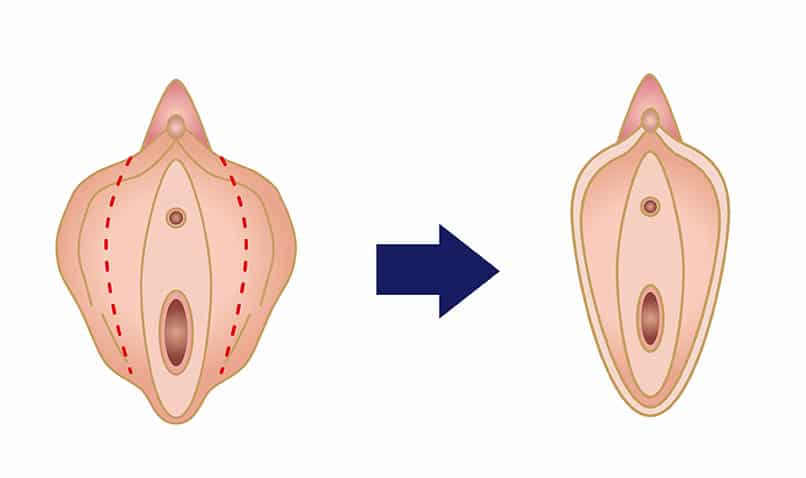 小陰唇縮小術の効果のイメージ