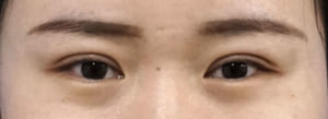 二重術（ビーズ法）症例写真　1ヶ月後