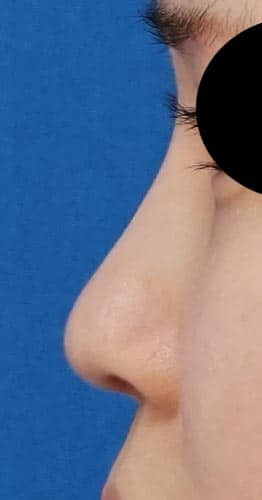 鼻尖縮小、鼻中隔延長、Ｉ型プロテーゼ　４ヶ月後　左側面像
