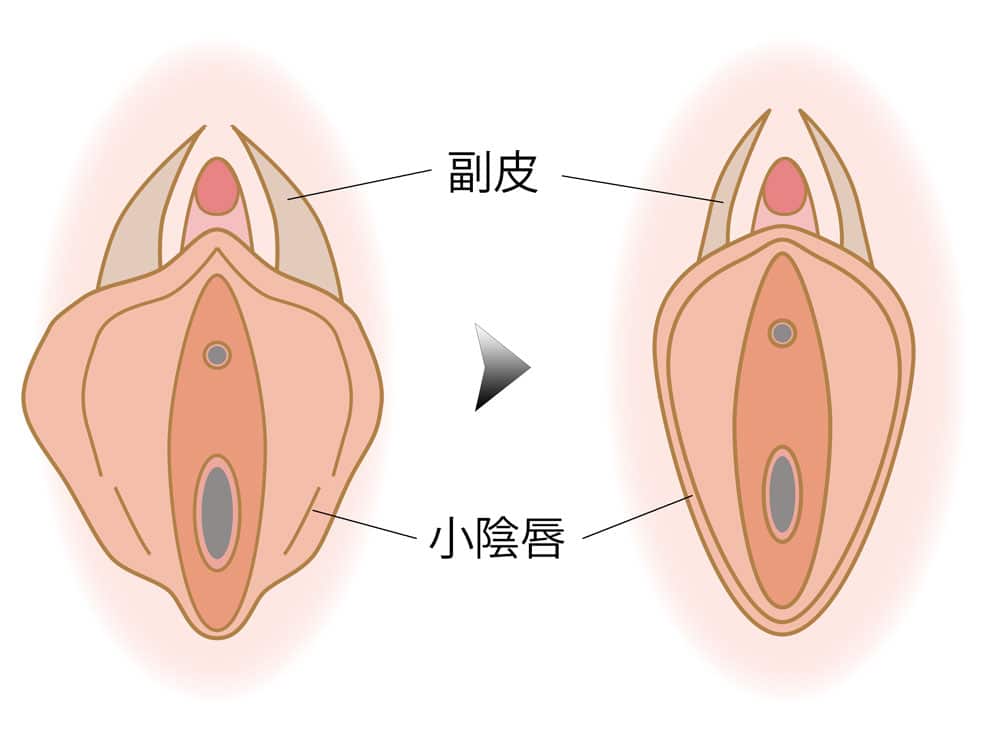 小陰唇縮小＋副皮切除した場合