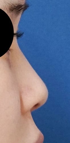 鼻尖縮小、鼻中隔延長、Ｉ型プロテーゼ　手術前　右側面