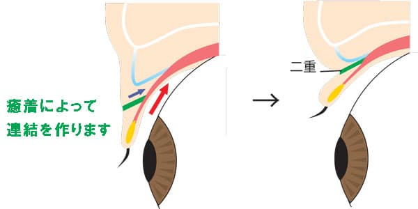 ビーズ法の構造（断面図）