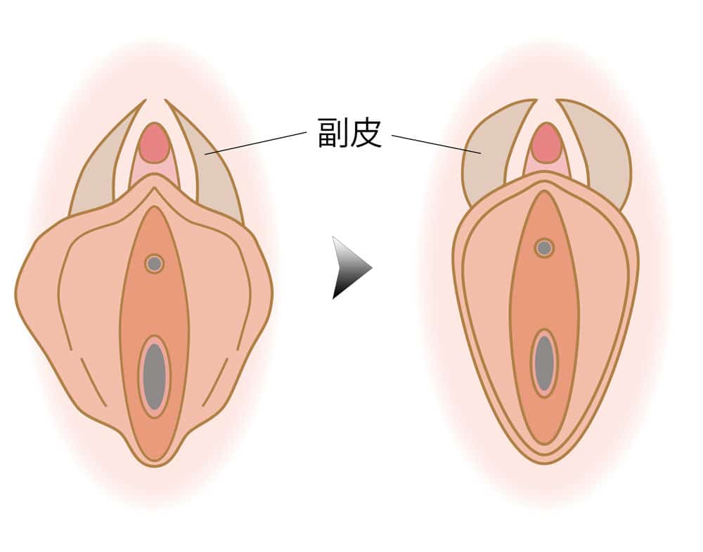 小陰唇縮小で副皮切除しなかった場合