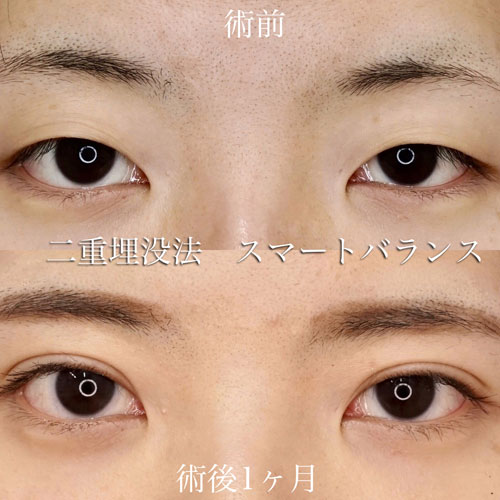 二重埋没法 もとび美容外科クリニック 二重埋没法 もとび美容外科クリニック