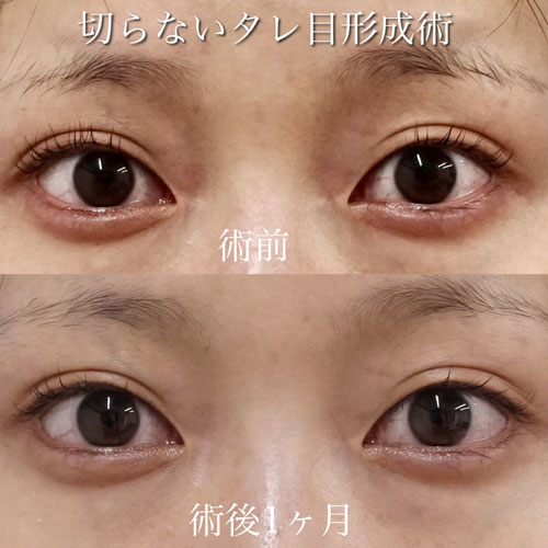 たれ目 もとび美容外科クリニック たれ目 もとび美容外科クリニック