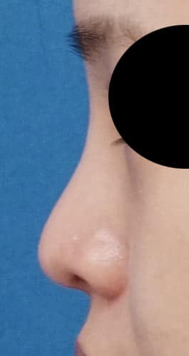 鼻尖縮小、軟骨移植、Ｉ型プロテーゼ　３ヶ月後　左側面のAfterの写真
