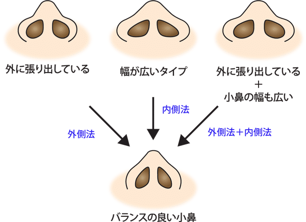 タイプ別鼻翼縮小の種類