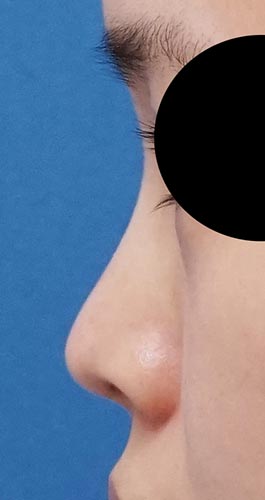 鼻尖縮小、軟骨移植、Ｉ型プロテーゼ　３ヶ月後　左側面のBefore写真