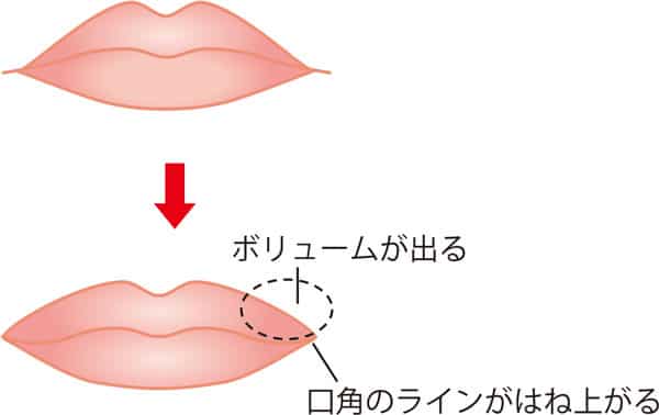 口角を上げるヒアルロン酸の効果のイラスト