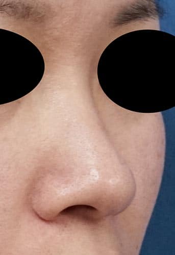 鼻尖縮小、小鼻縮小（内側法、Flap法）（他院修正）　３ヶ月後　右斜めのBefore写真