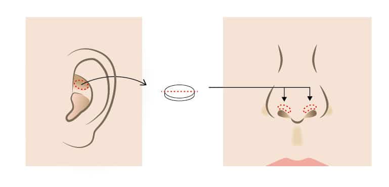 鼻の穴を目立ちにくくする鼻孔縁延長のイラスト