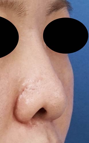 鼻尖縮小、鼻孔縁延長　６ヶ月後　右斜めのBefore写真