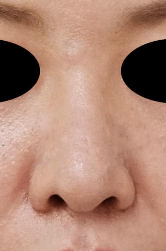 鼻尖縮小、鼻孔縁延長 6ヶ月後 正面のAfterの写真
